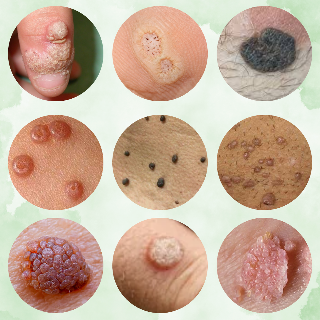 AdFire™ Eliminador Total de Verrugas e Imperfecciones_medicado