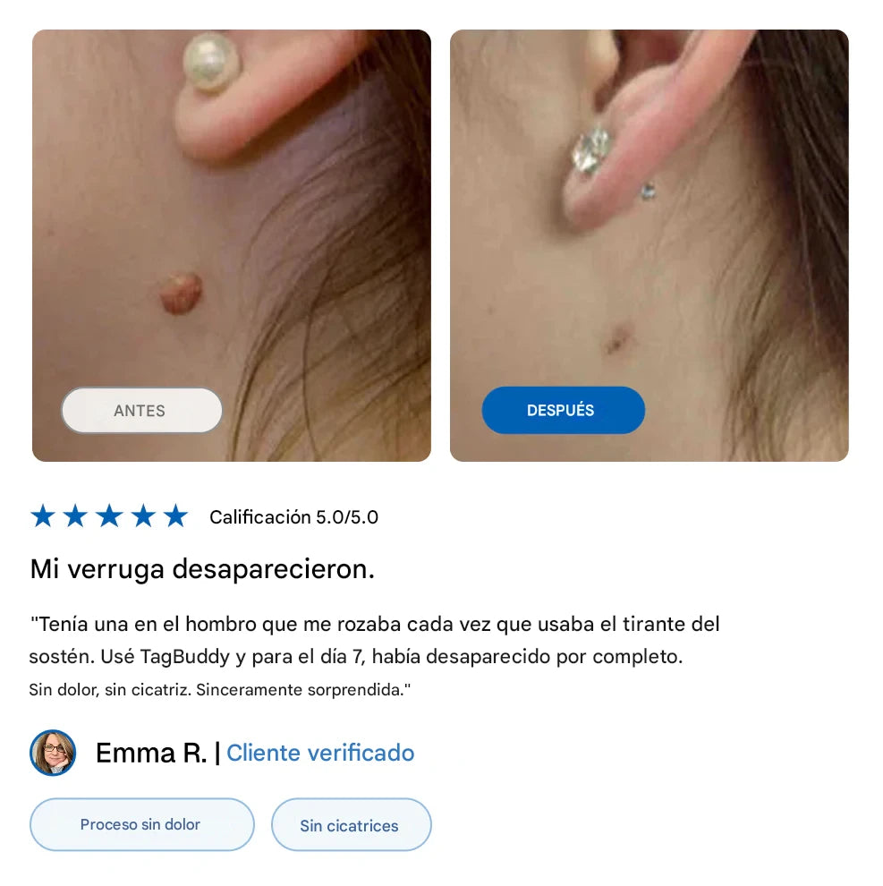 TagBuddy Kit - No Mas Verrugas