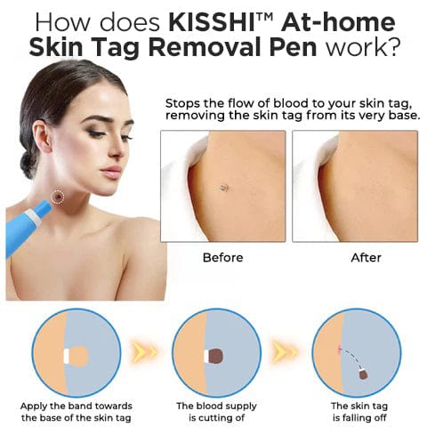 KIT para eliminar verrugas cutáneas en casa KISSHI™