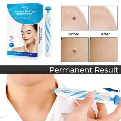 KIT para eliminar verrugas cutáneas en casa KISSHI™
