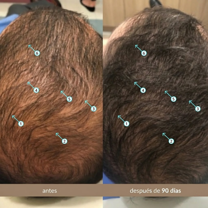 Sérum Avanzado De Densidad Capilar Con Nanoxidil 5%