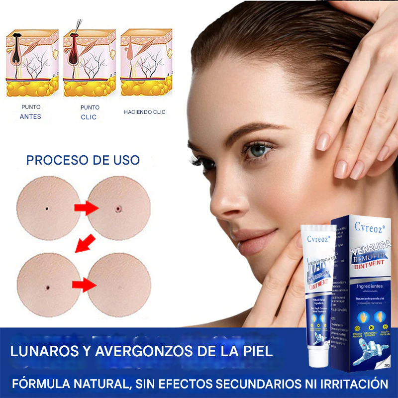 Crema de tratamiento de verrugas corporales para eliminación de verrugas Cvreoz®