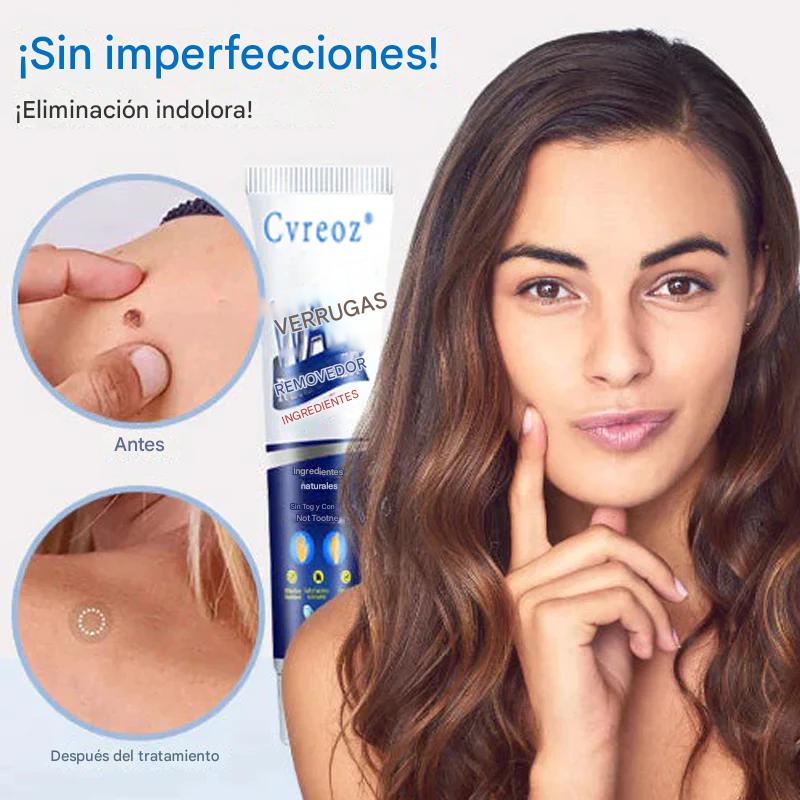 Crema de tratamiento de verrugas corporales para eliminación de verrugas Cvreoz®