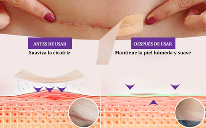 Flysmus® ReGen Cinta de Micronadles con Ácido Hialurónico Nano-Heal 💝