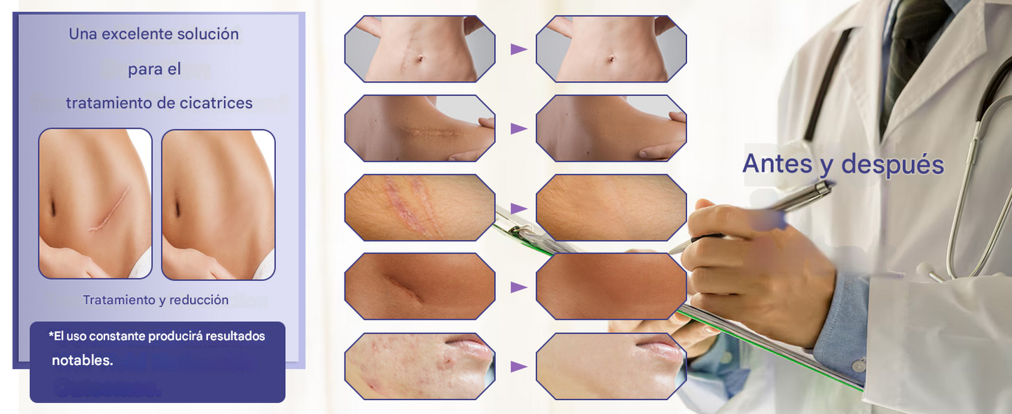 Flysmus® ReGen Cinta de Micronadles con Ácido Hialurónico Nano-Heal 💝